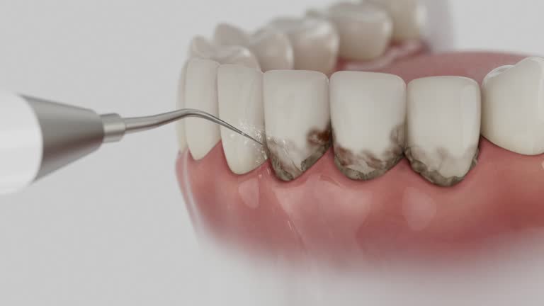 Trusted Wisdom Tooth Removal service in Johnson Lane, NV - Dentist Open Now